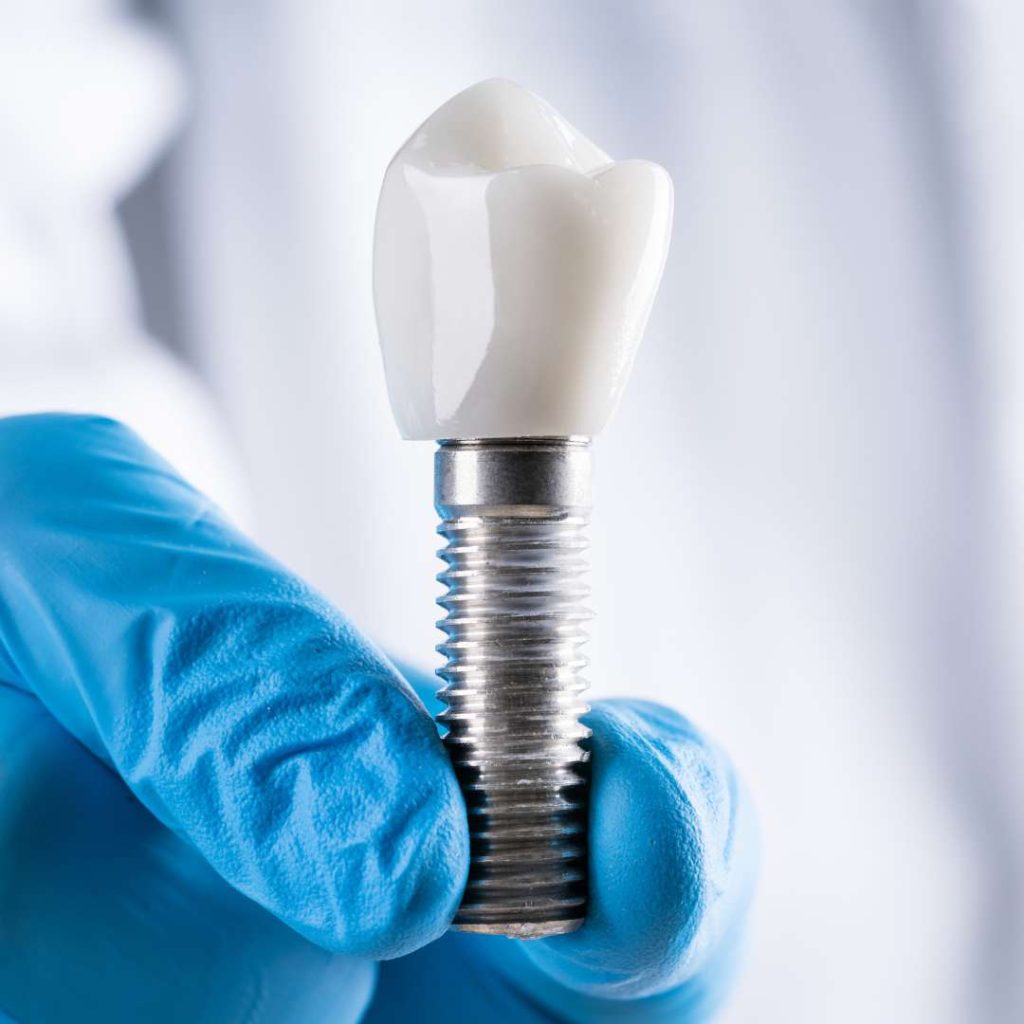 Implantes dentales