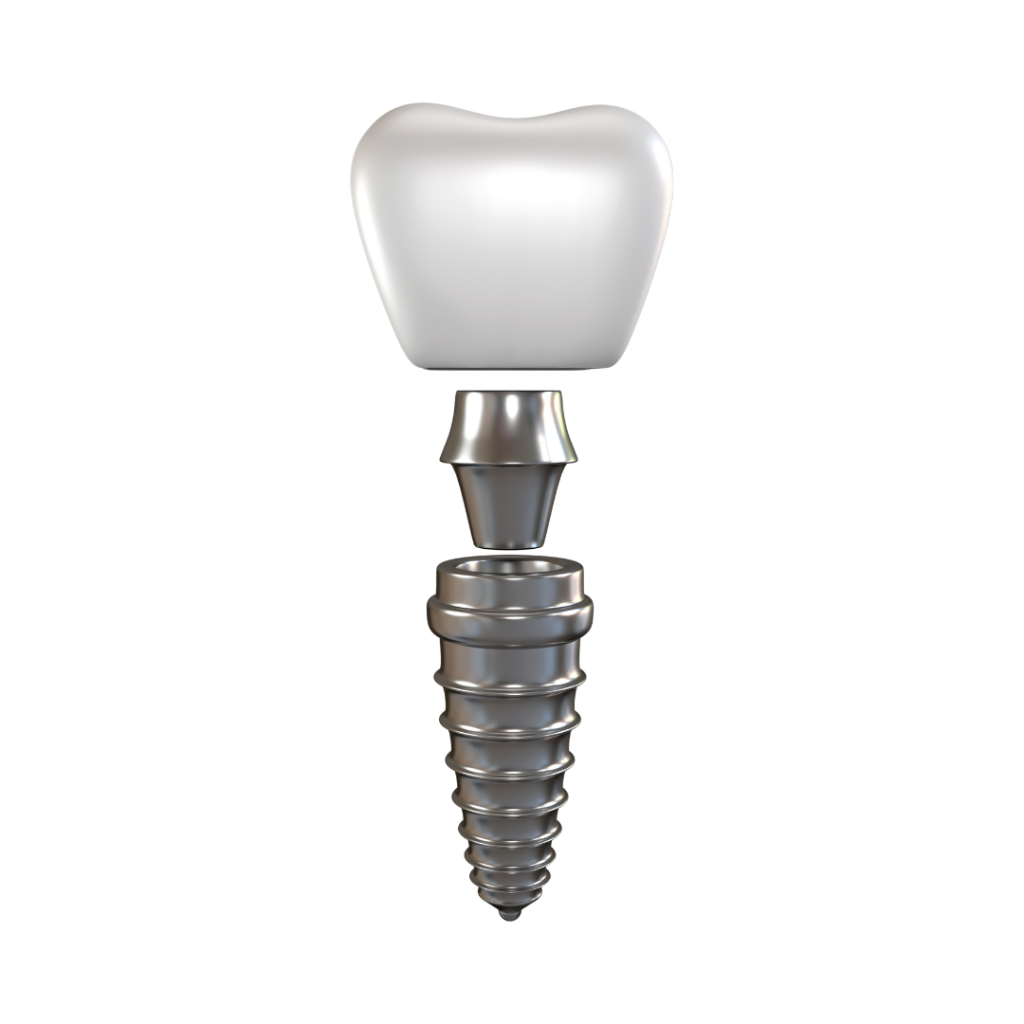 Implantes dentales